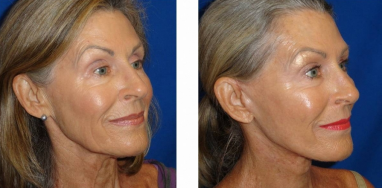 facelift-before-and-after-woman-over-50