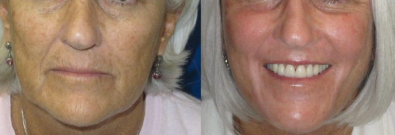 laser-skin-resurfacing-62-woman