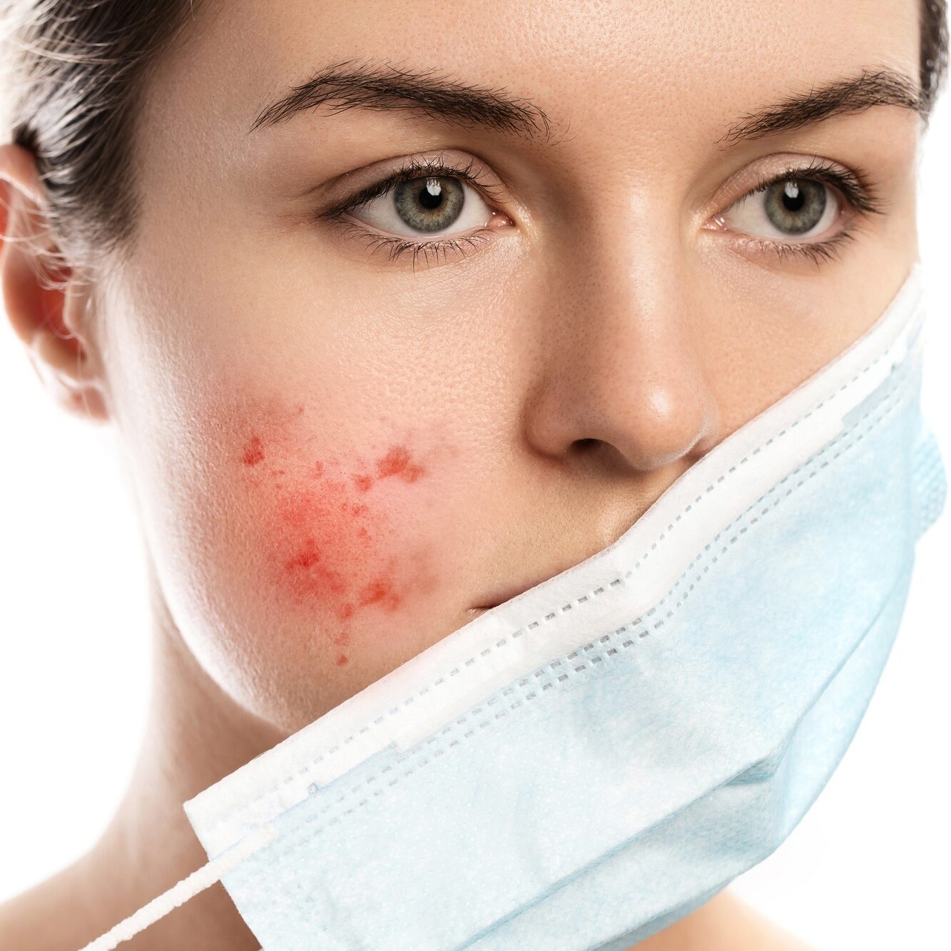 <br>Rosacea<br><br>