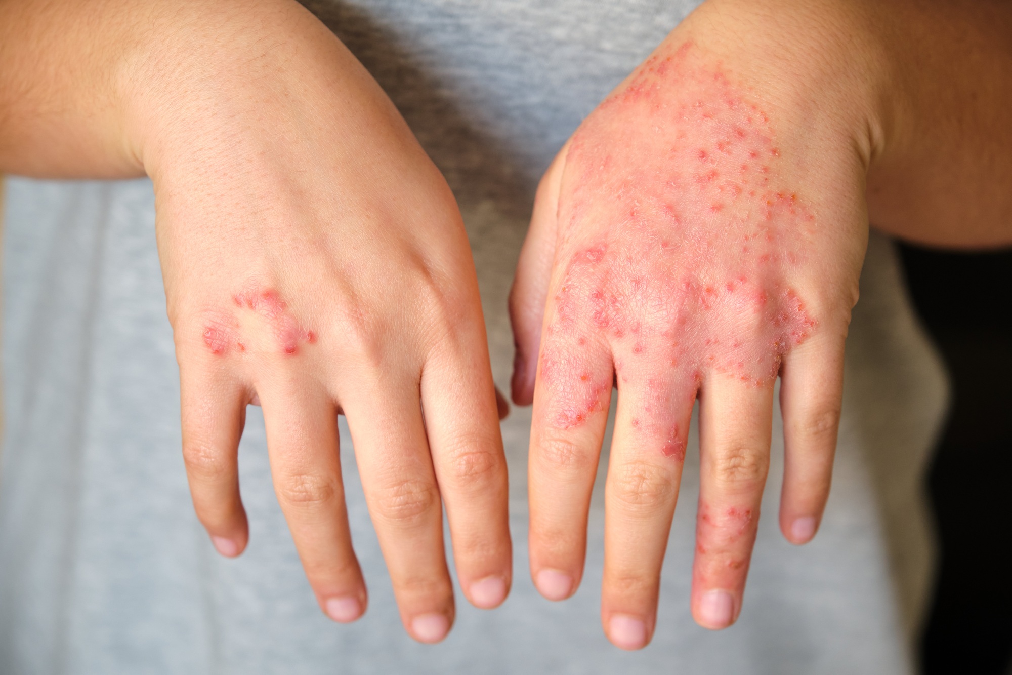 Eczema