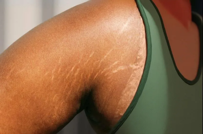 Laser Surgery for Stretch Marks  