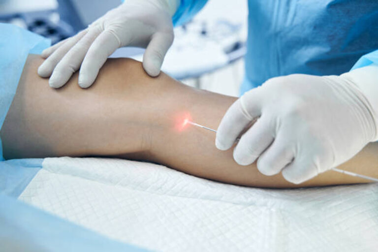 endovenous-laser-ablation