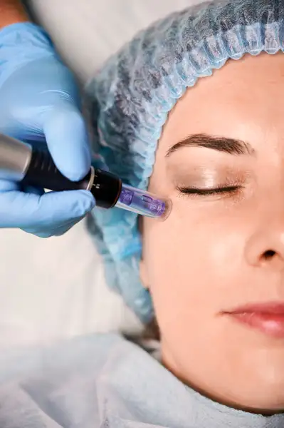 Microneedling + PRP