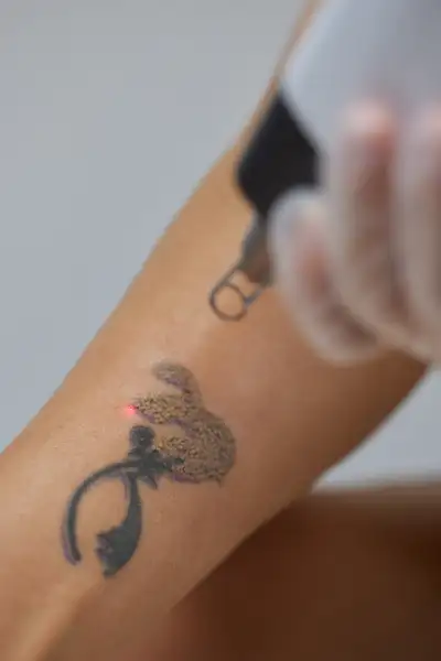 Tattoo Removal