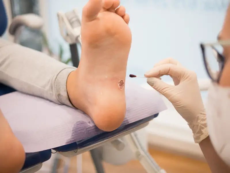 Warts Removal